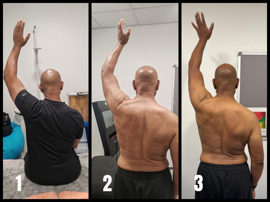 a male's shoulder mobility progressive image showing a significant improvement in left shoulder's overhead reach and flexion